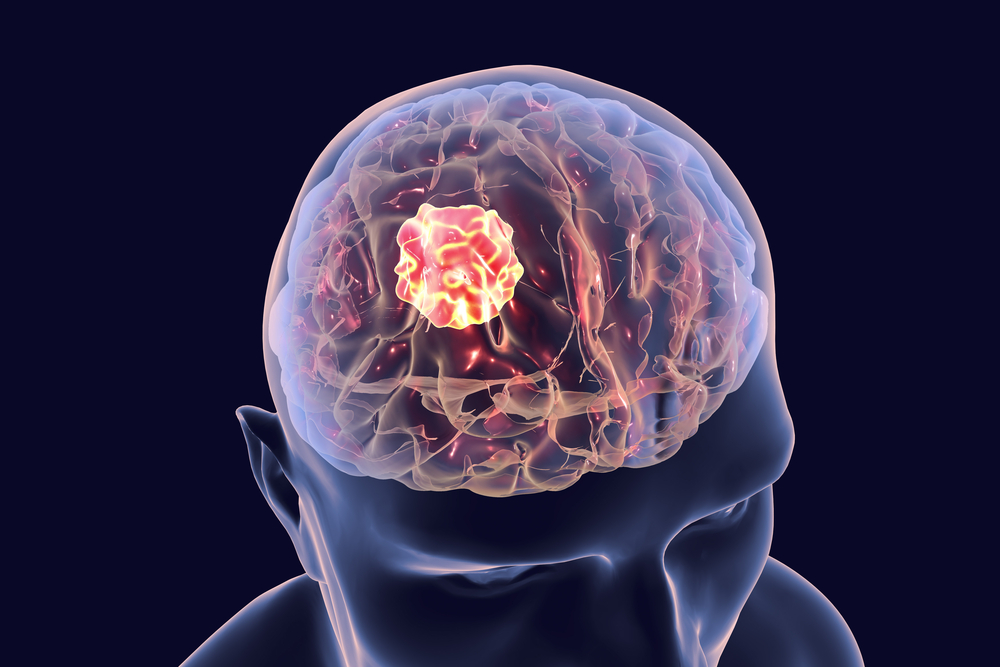 Brain,Cancer,,3d,Illustration,Showing,Presence,Of,Tumor,Inside,Brain